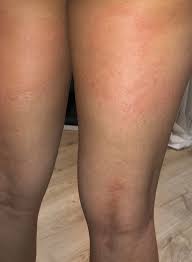 This is the most specific covid rash as not many other skin conditions present in this way. Skin Rash Should Be Considered As A Fourth Key Sign Of Covid 19