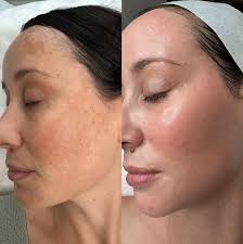 Some of my favourite skin transformations. Which one do you love?  #jennadeeskin #beforeandafterskin #northlakes #brisbane #northlakesbeauty  #northlakesskinclinic