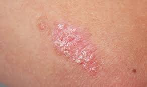 One of the most popular skin cancer natural treatment options is coconut oil. Can Skin Cancer Be Itchy And Scaly Cancerwalls