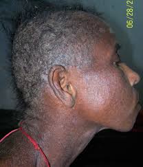 Tropical Diseases of the Skin