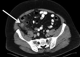 충수염(盲腸炎,蟲垂炎, appendicitis)은 맹장 중 충수(막창자꼬리) 부위에 염증이 생긴 것으로, 충수염이 바른 말이나 일반적으로 맹장염이라고 불린다. Non Operative Management Of Acute Appendicitis In A Patient With Ulcerative Colitis Surgical Infections Case Reports