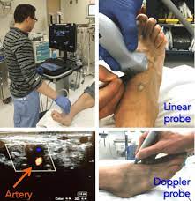 Trick Of The Trade: Ultrasound For Pedal Pulse Identification And Abi