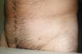 Image result for genital warts