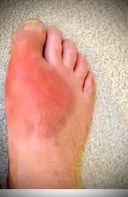 Image result for gout symptoms toe