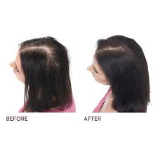 Men who begin to notice a bit of early thinning with hair loss starting at the vertex of their scalp, but who aren't completely bald, have the best chance to slow. Keranique The Complete Hair Regrowth System For Deep Hydration Ulta Beauty
