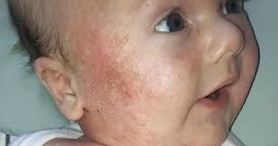 Baby's eczema so bad people thought he'd been burned cured with simple  cream