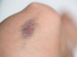 Prellungen, verstauchungen und blutergüsse zählen zu den häufigsten verletzungen an muskeln und. Blauer Fleck Bei Beule Zum Arzt Berlin De