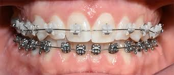 If your child is getting braces, your orthodontist will supply orthodontic wax to help ease discomfort. Ceramic Braces Are They Right For You Find Out Now