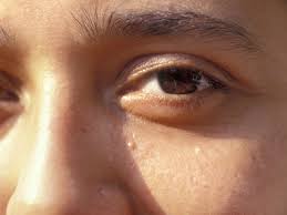 Milia are small white bumps occurring on the skin near the eyes, cheeks and nose of your face. Milia Causes Treatments And Removal Of Tiny White Facial Bumps Allure