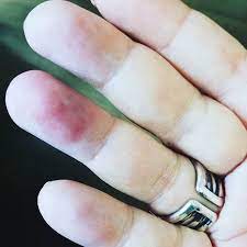 やってもうた まだ冷ましてない鍋のふたに右薬指の腹をジュッと 急いで冷やしたけど結構痛い 指は仕事で使うから作業効率がああ不注意 火傷 やけど 痛い 不注意 反省 silver rings beauty rings