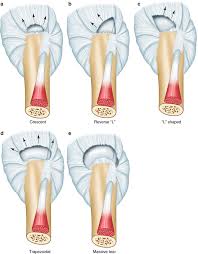 Image result for Rotator Cuff Rupture