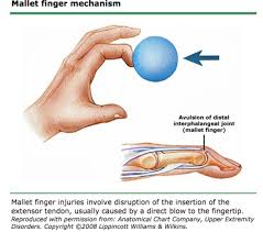Mallet finger is the term applied to extensor avulsion fractures or distal extensor tendon ruptures. Finger Injuries Core Em
