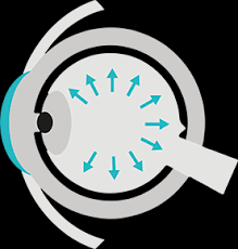 Glaucoma is the second leading cause of blindness. Topics Startseite De Glaucoma Oculus Optikgerate Gmbh