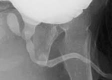 Image result for where is the prostatic utricle course hero