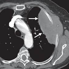 Various investigations are underway to reduce this disease. Small Cell Lung Carcinoma Staging Imaging And Treatment Considerations Radiographics