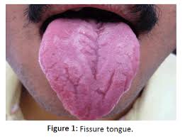Image result for Fissured tongue