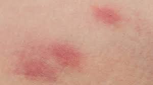 What are the symptoms of kidney failure? Rash 22 Common Skin Rashes Pictures Causes And Treatment