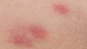 Can Fleas Live On Humans And Bite Us Treatment And Prevention Fleas do not live on humans because they lack substantial hair like animals, and it's very difficult to reproduce without the protection of fur or feathers. healthline