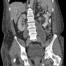 Frontal view of the CT scan. The yellow arrow shows L4-L5...