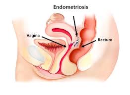 Endometriosis is a full body condition in which cells similar to those in the endometrium, the layer of tissue that normally covers the inside of the uterus, grow outside the uterus. Endometriosis Of The Bowel Endomhtriwsh Dr Kyriakopoylos Kwnstantinos