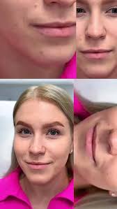 Let’s refresh our memory ✨, Once again, I want to show you the  transformation of my beautiful client after just one treatment — hyaluronic  acid lip injections., Look how natural this enhancement ...