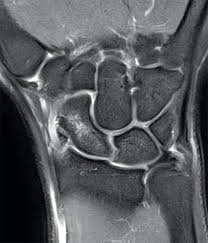 Image result for Scapholunate Dislocation