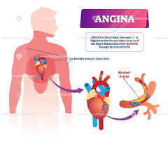 Diagram of chest area posted on july 2, 2015 by admin when we are doing cpr why do compress the sternum area not rh quora com human chest anatomy chest diagram area download smartphone medium size full back to diagram of stomach area figure 1 a pain diagram showing the referred area. Pin On Health And Medicine Illustrated