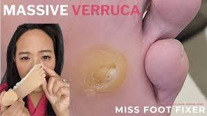 Image result for verruca