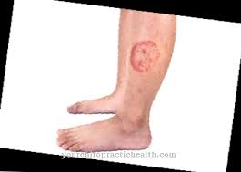 D g yang mana musti kupilih. Tinea Dermatophytosis Punca Gejala Rawatan Penyakit