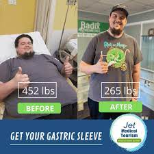 There you can find before and after pics from real patients. Gastric Sleeve Before And After Pictures Best Vsg Photos 2021