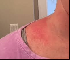 The Rash That Wouldn T Quit Kara Fitzgerald Nd Naturopathic Doctor