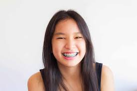 Braces which the wire is secured with elastic bands. Conventional Braces Treatment Kl Selangor Smile Beauty
