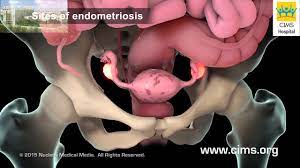 Symptoms of endometriosis include pelvic pain, bad periods, and fertility problems, yet many have no symptoms. Endometriosis Hindi Cims Hospital Youtube
