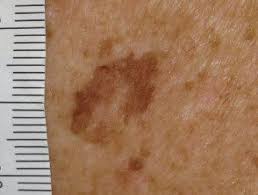 Image result for Solar Lentigo