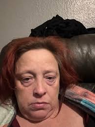 I hate dialysis spot my problem 🥲