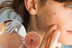 Image result for skin cancer on nose pimple