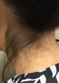 Did you know how to remove unwanted hair? Back Of Neck Hair Removal Patient 0649 Before And After Gallery