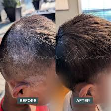 Image result for Tinea Capitis