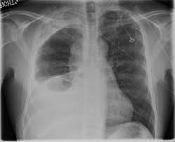 They show pictures of your internal tissues, bones, and organs. Cureus A Rare Case Of Malignant Pleural Mesothelioma In A Young Healthy Male Without Asbestos Exposure