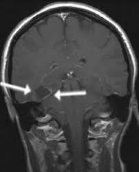 Klinik Und Poliklinik Fuer Neurochirurgie Gliome