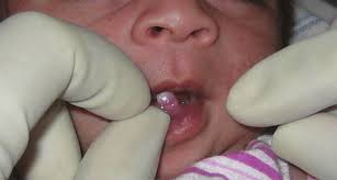 Image result for Neonatal Teeth