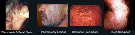 This form of acne can occur anywhere on the body, but it is most common on the neck. Chloracne
