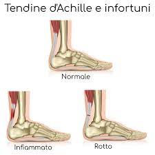 Tale ferita può colpire la parte posteriore della gamba e portare. Rottura Del Tendine D Achille Cause Sintomi E Cura