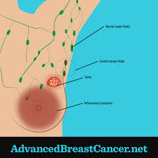 What are the symptoms of inflammatory breast cancer? How Does Inflammatory Breast Cancer Begin