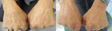 Image result for liver spots on legs