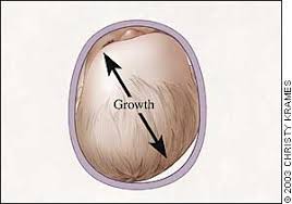 Image result for Positional Head Deformity