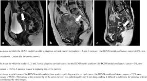 Cervical cancer screening is used to find abnormal cells in your cervix that could lead to cancer. Diagnosing Uterine Cervical Cancer On A Single T2 Weighted Image Comparison Between Deep Learning Versus Radiologists European Journal Of Radiology