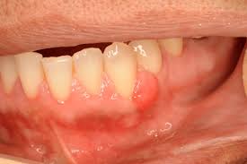 Image result for gums cancer symptoms