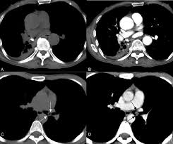 This is not a malignant tumor, and it grows hamartomas, while generally benign, can cause problems due to their location. A D Endobronchial Hamartoma Demonstrating Patchy Areas Of Enhancement Download Scientific Diagram