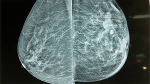 Image result for Mammogram Interpretation